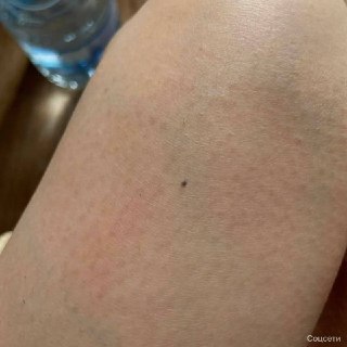 Микроклещи в Рыбинских лесах: угроза здоровья